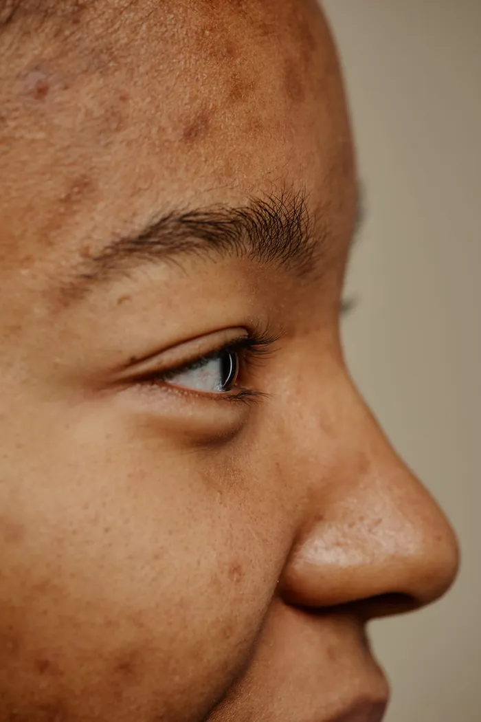 Skin with hyperpigmentation
