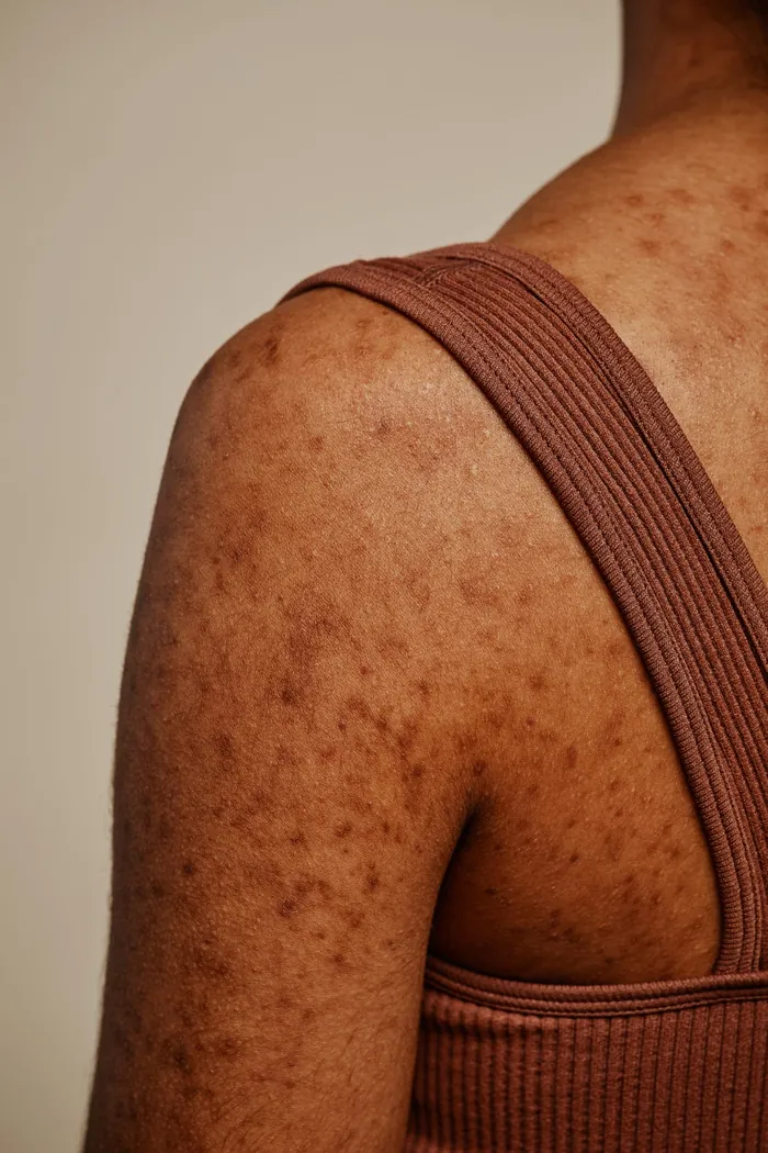 Freckles and sun spots on a shoulder